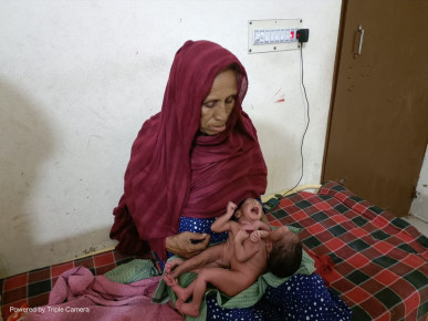 পাবনায় বুক ও পেট জোড়া লাগানো জমজ শিশু নিয়ে চাঞ্চল্য